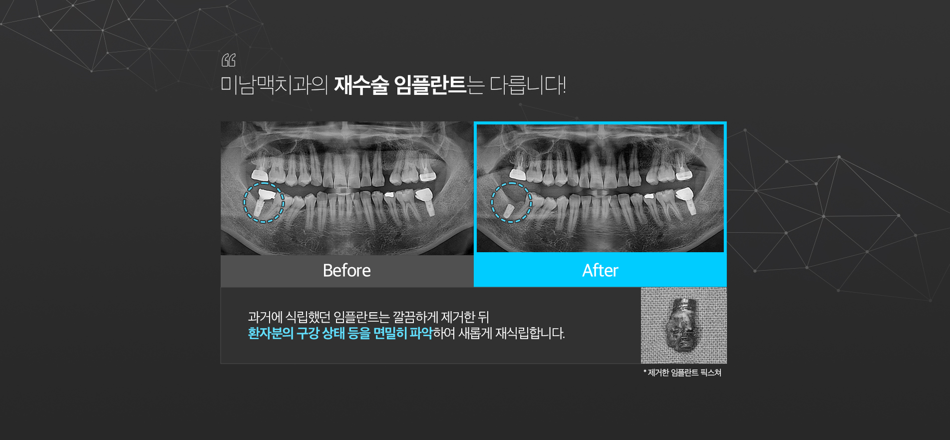임플란트 재수술