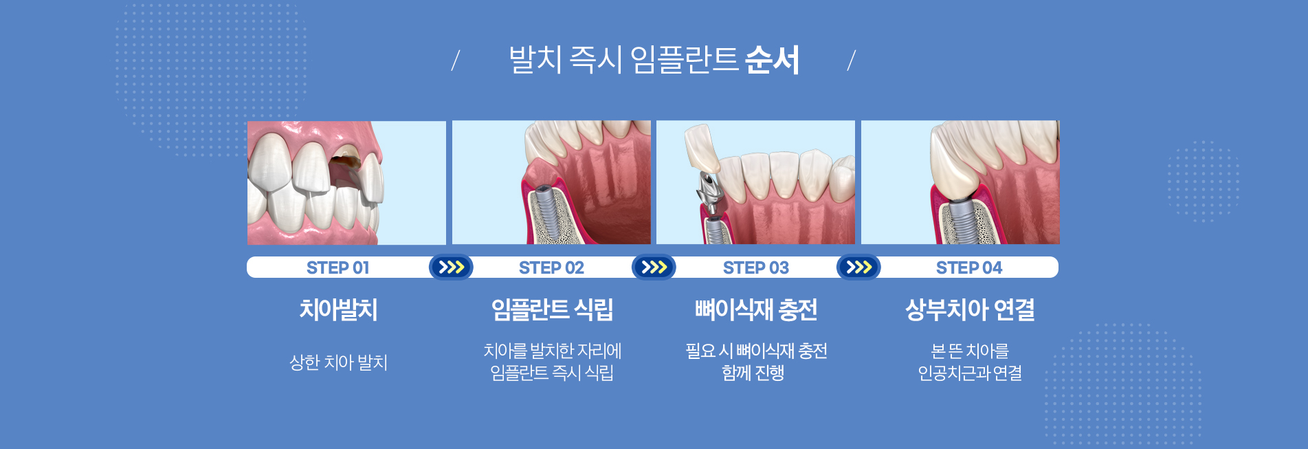 발치즉시임플란트