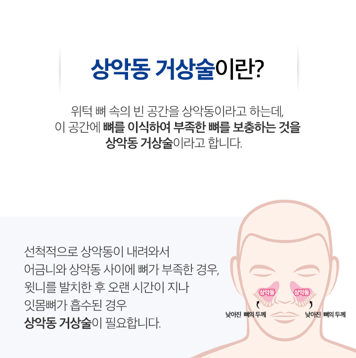 상악동 거상술
