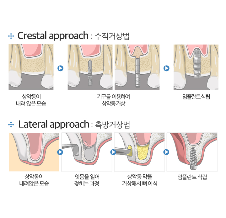 상악동 거상술