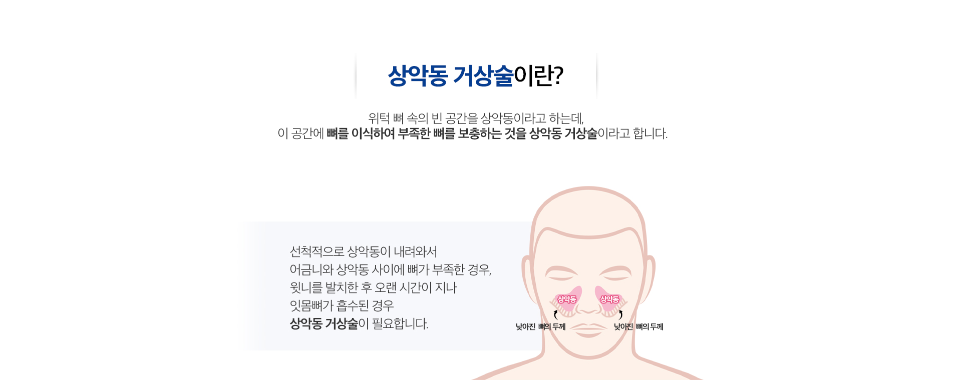 상악동 거상술
