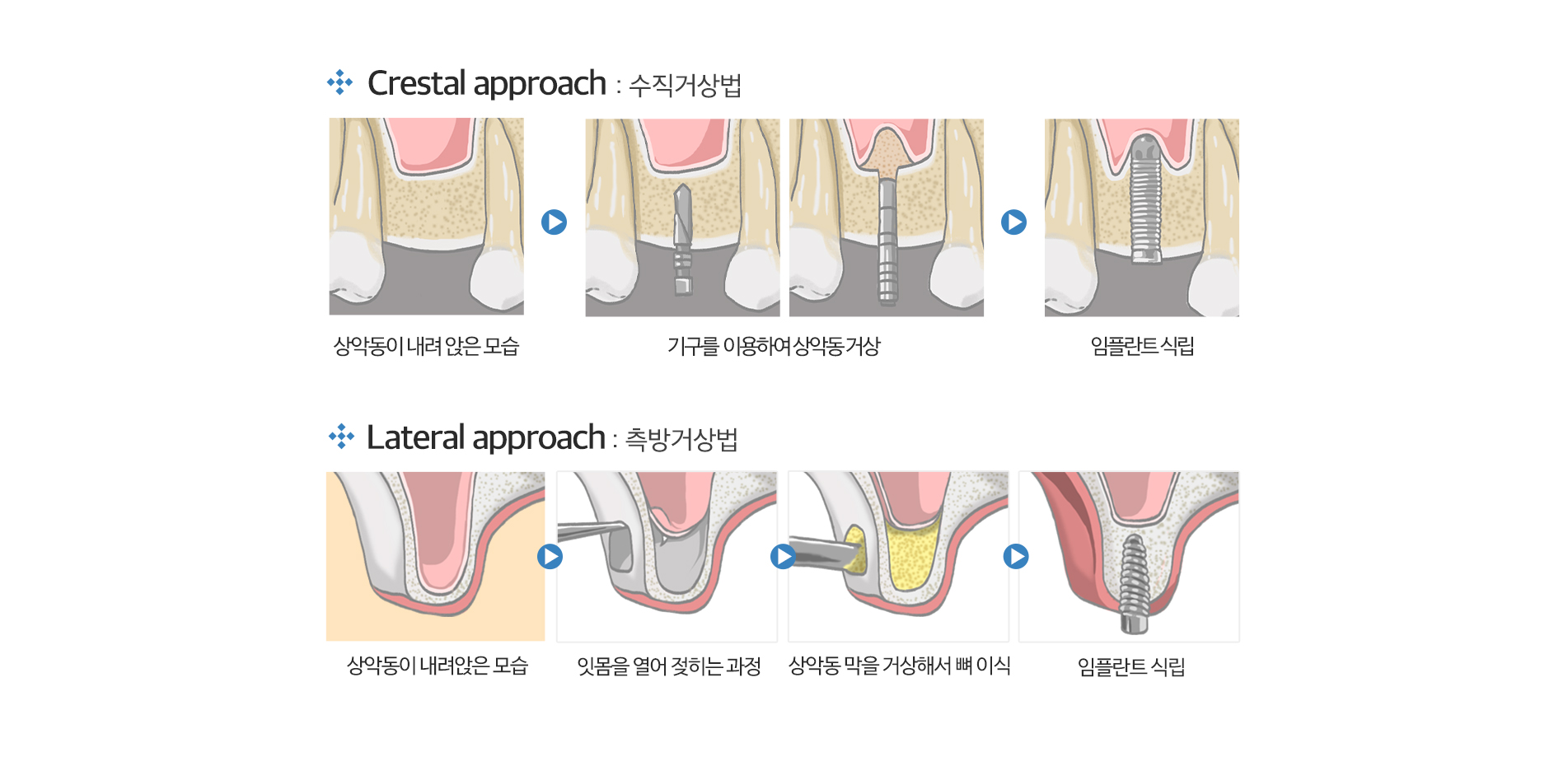 상악동 거상술