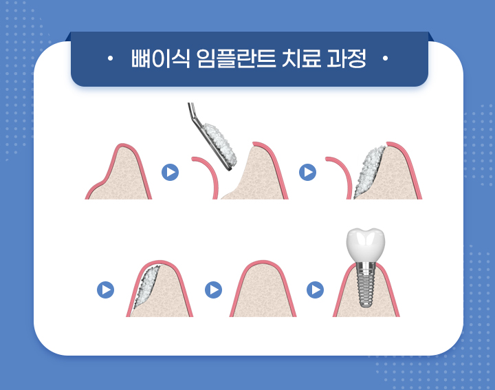 뼈이식 수술
