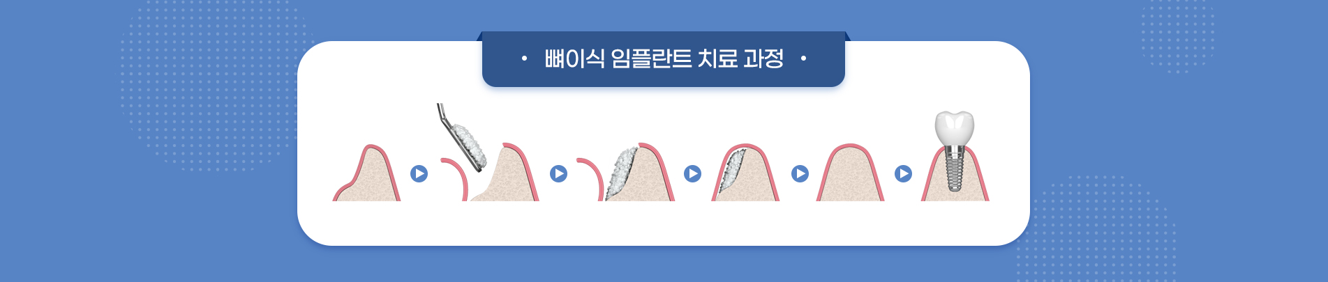 뼈이식 수술