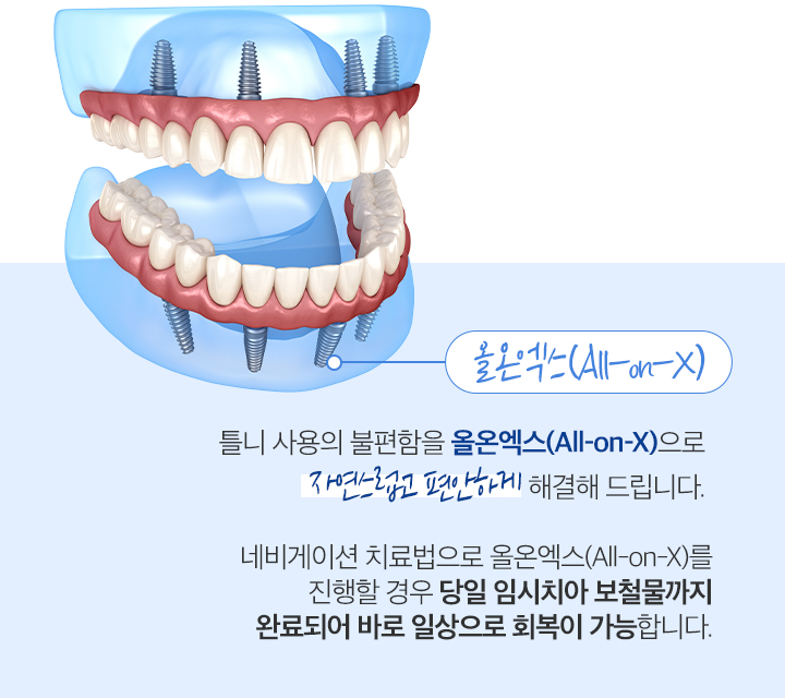 올온엑스(All-on-X)