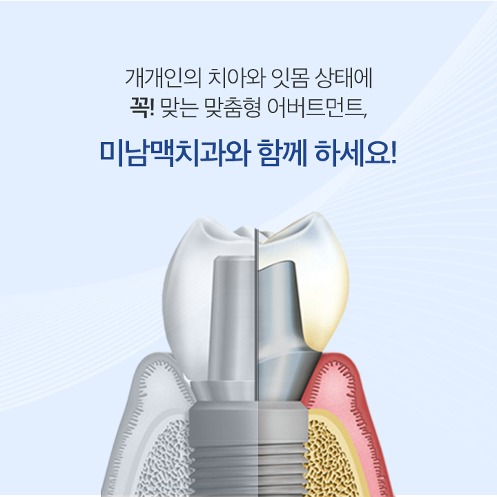 맞춤형 어버트먼트