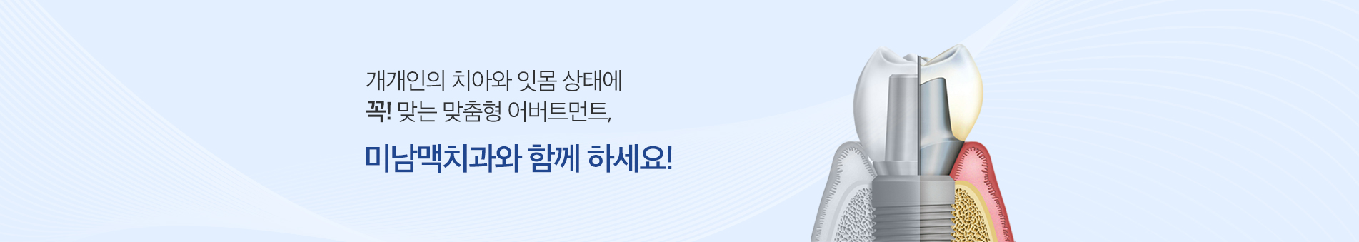 맞춤형 어버트먼트