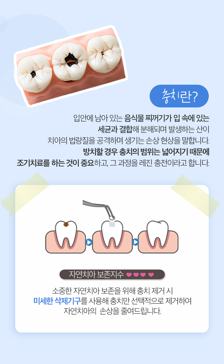 레진충전