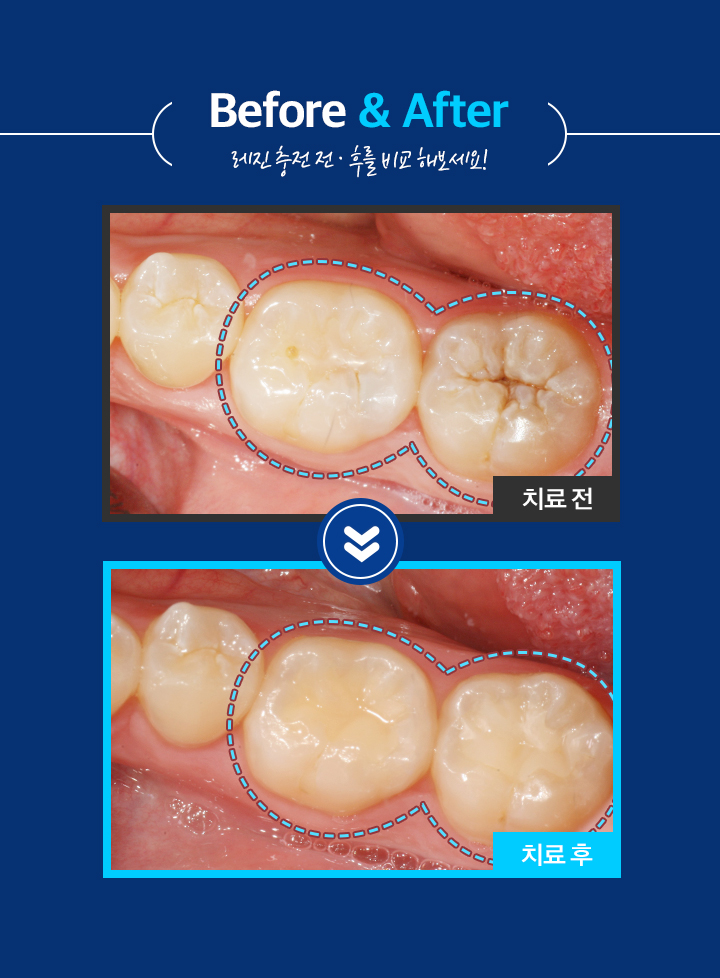 레진충전