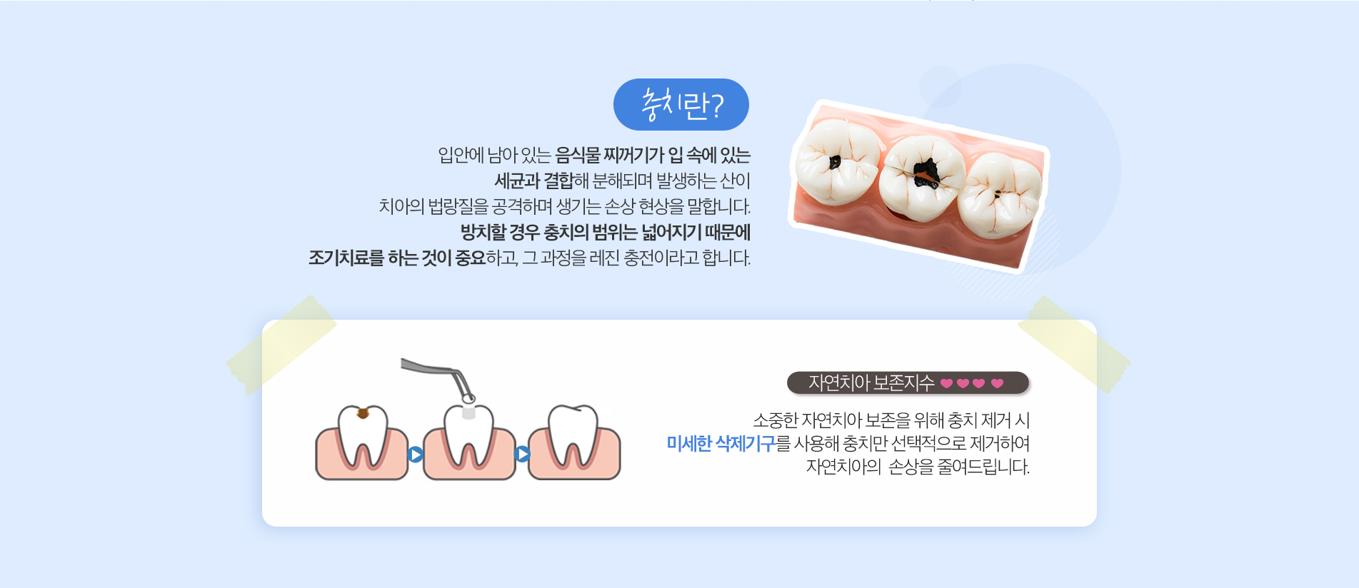 레진충전