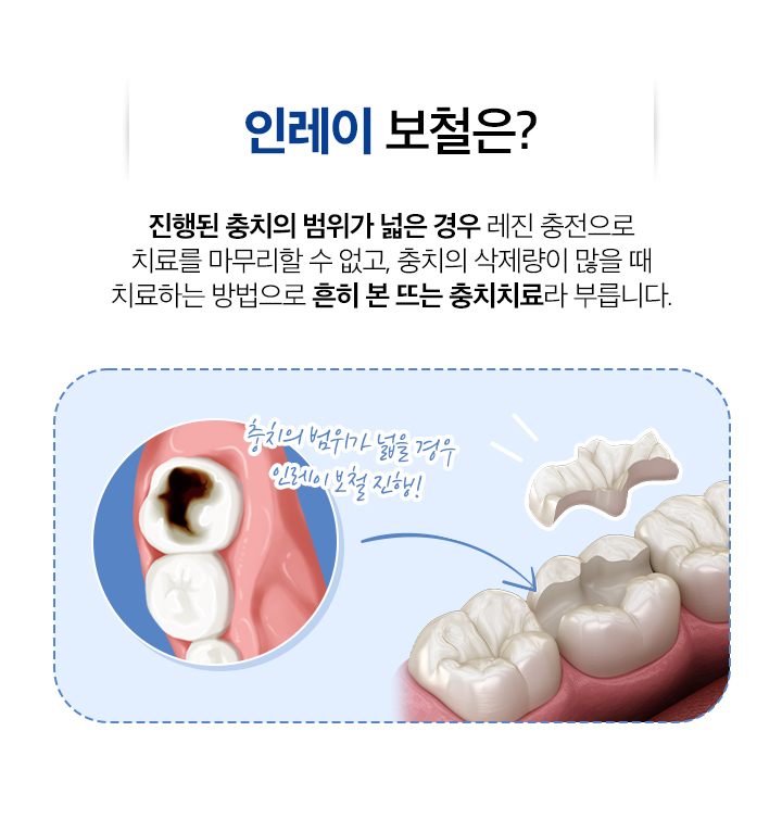 인레이보철