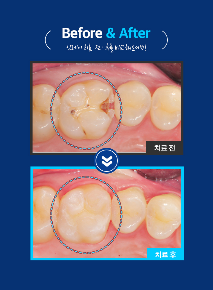 인레이보철