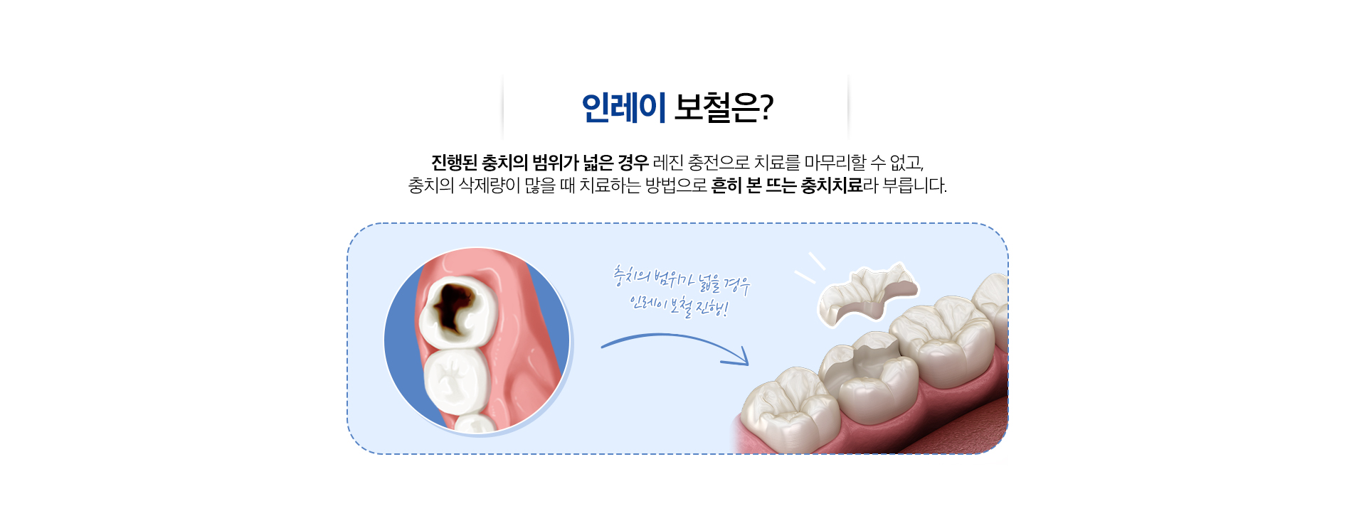 인레이보철