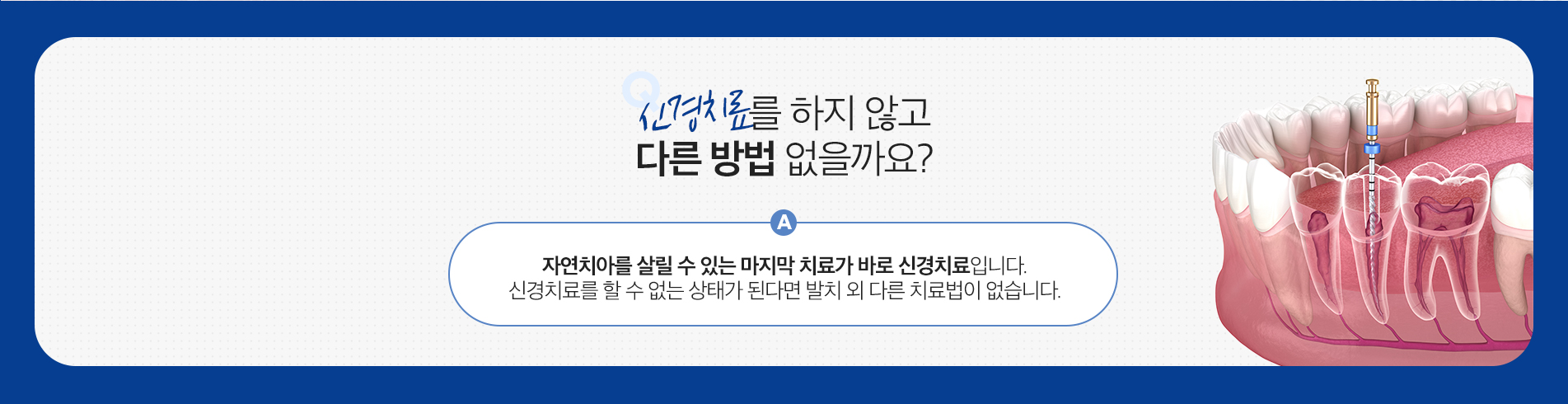 신경치료