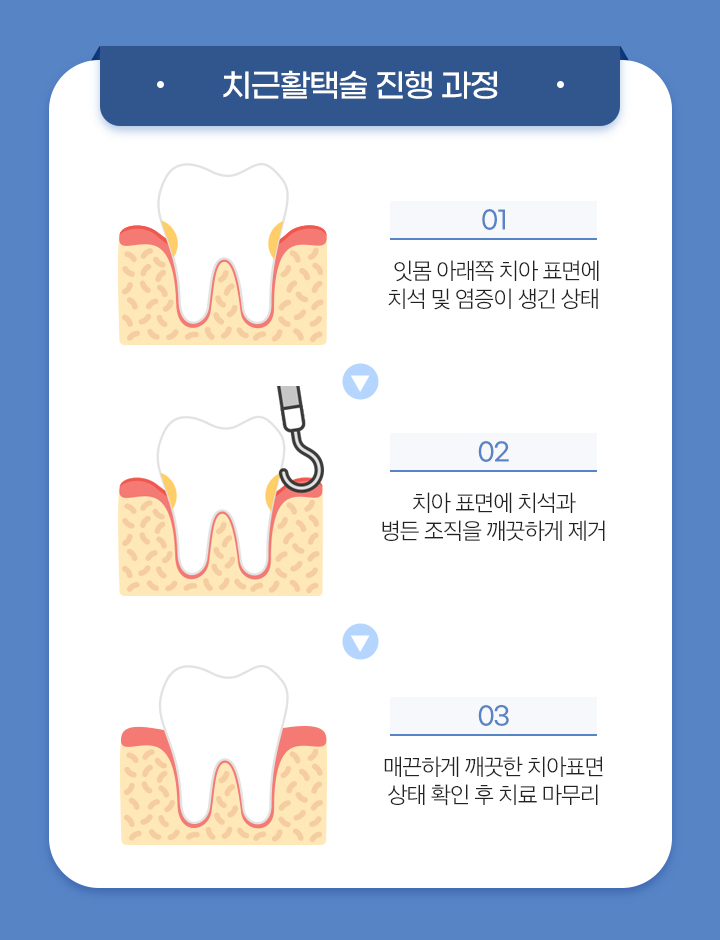 치근활택술