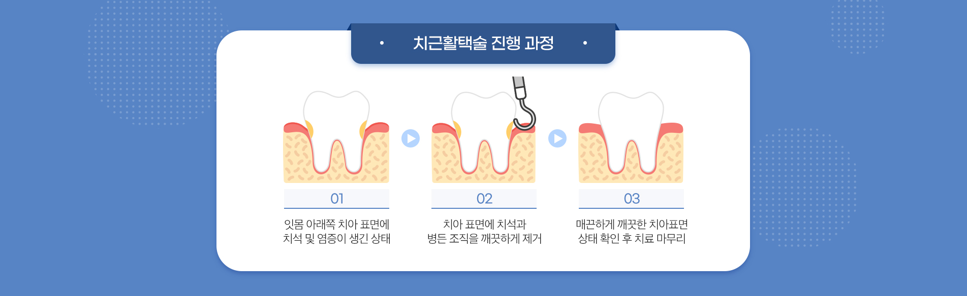 치근활택술