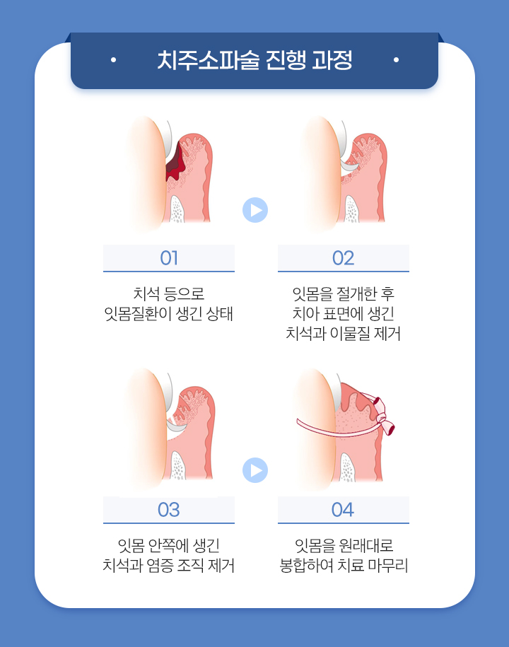 치주소파술