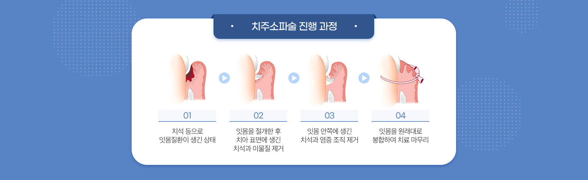 치주소파술