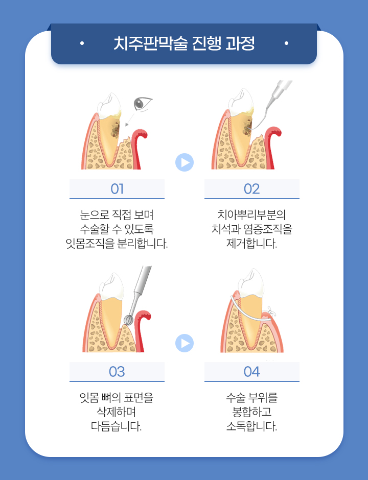 치주판막술
