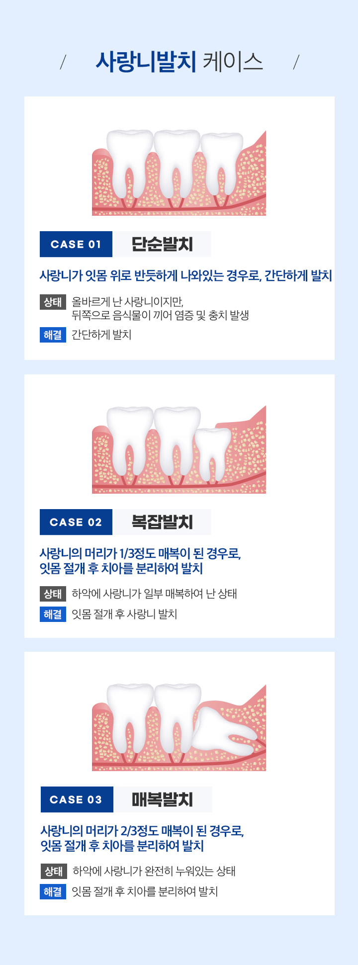 사랑니발치