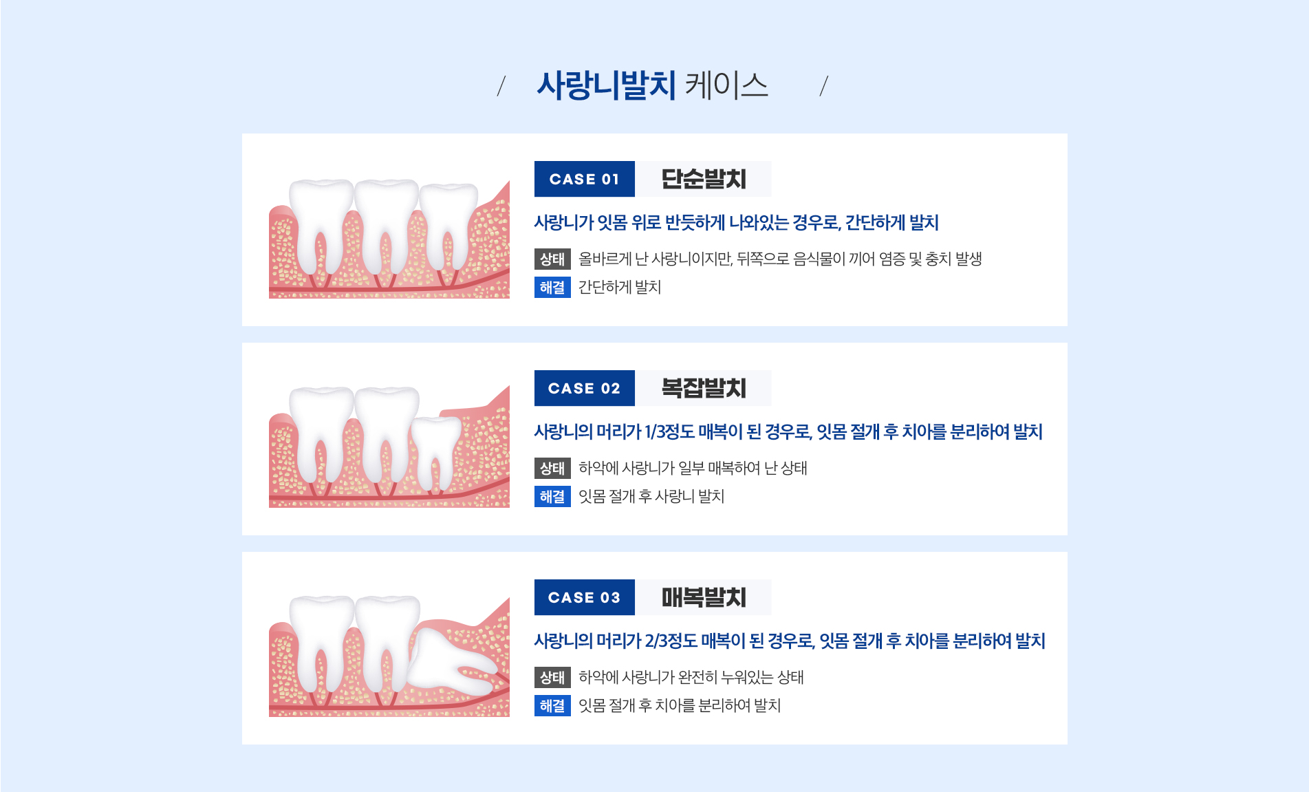 사랑니발치