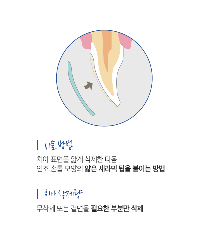 무삭제라미네이트