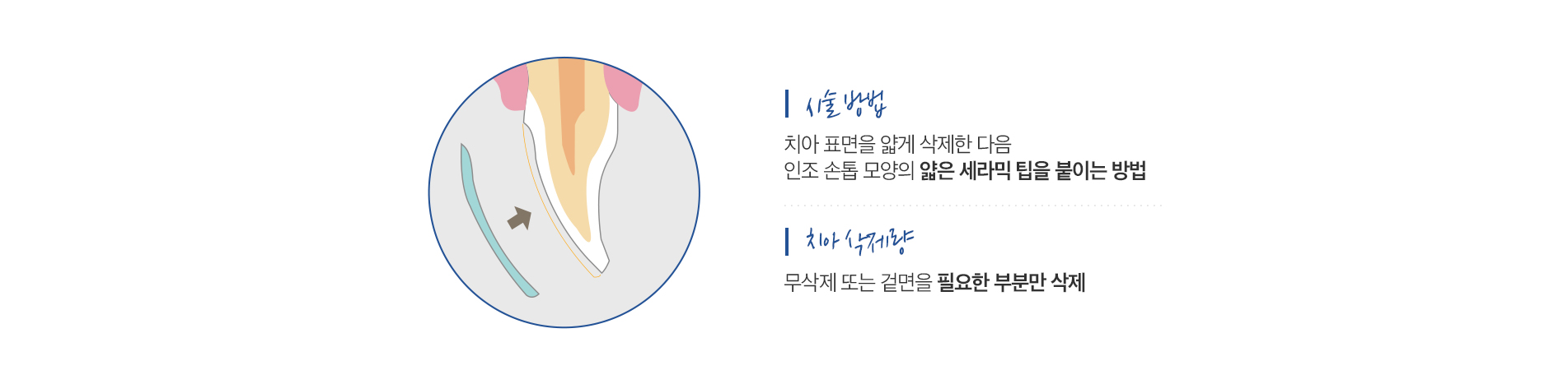 무삭제라미네이트