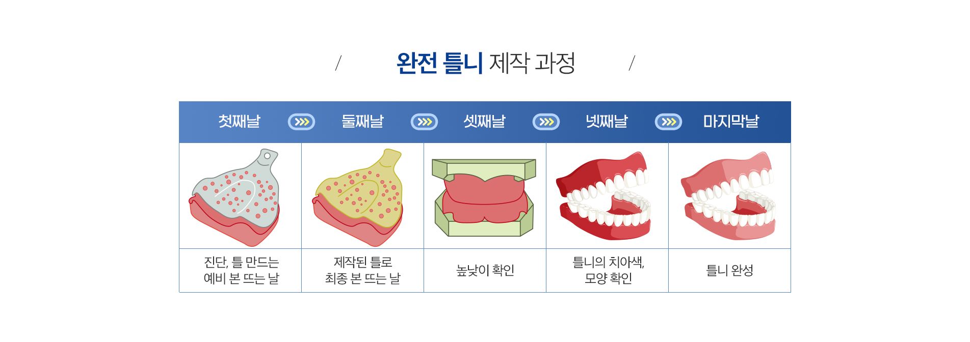 완전틀니