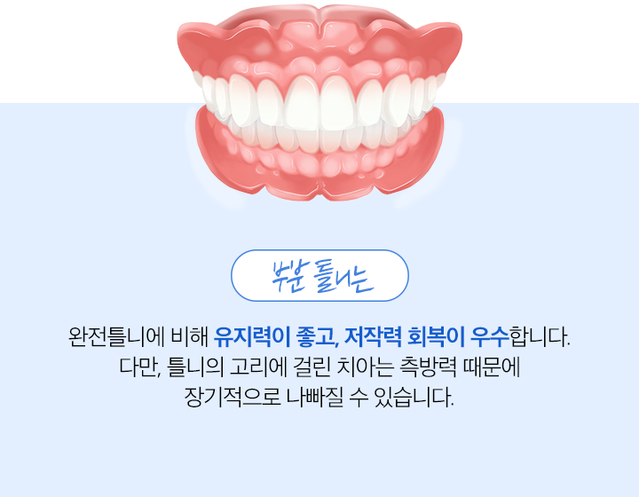 부분틀니