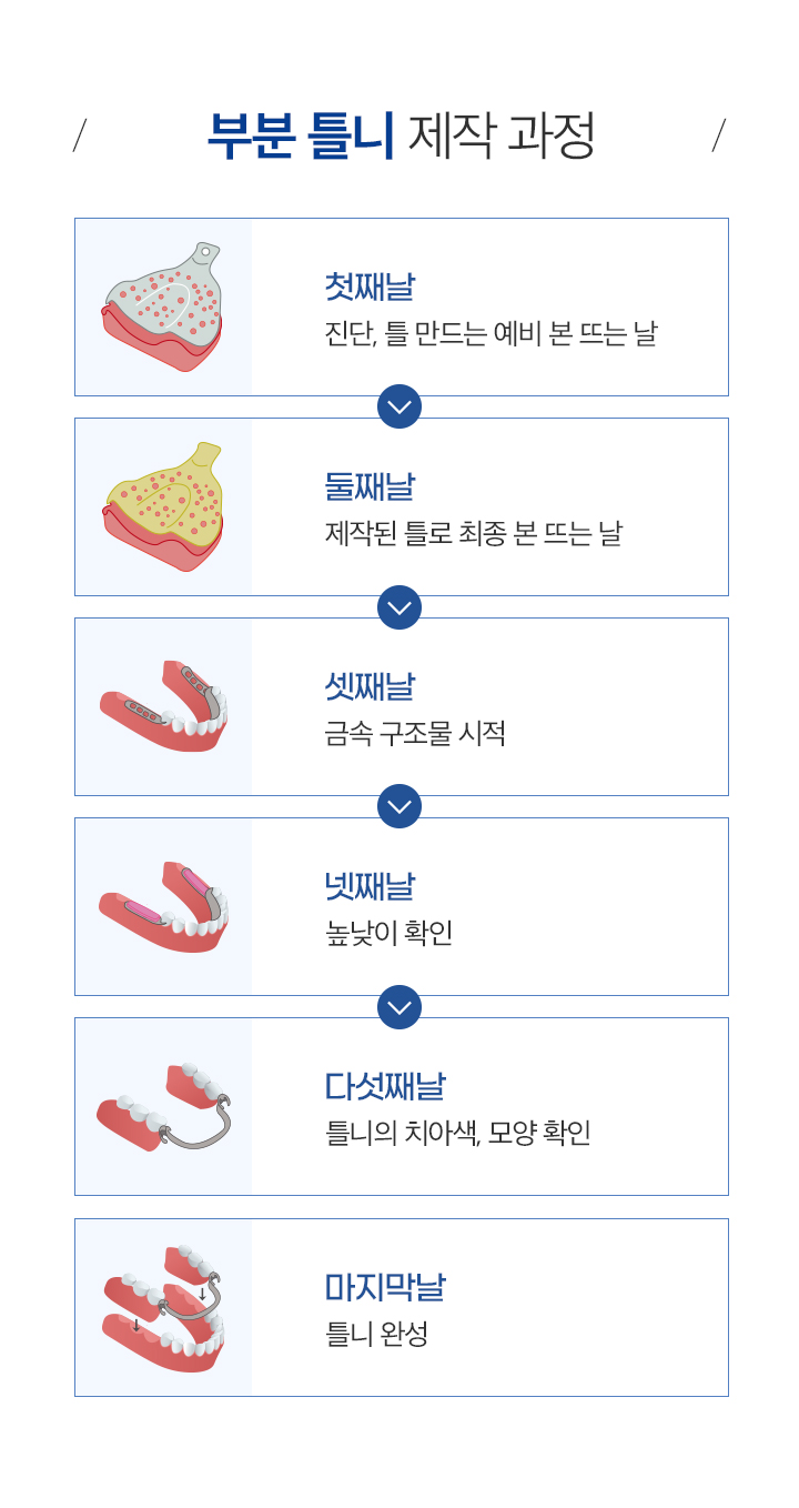 부분틀니