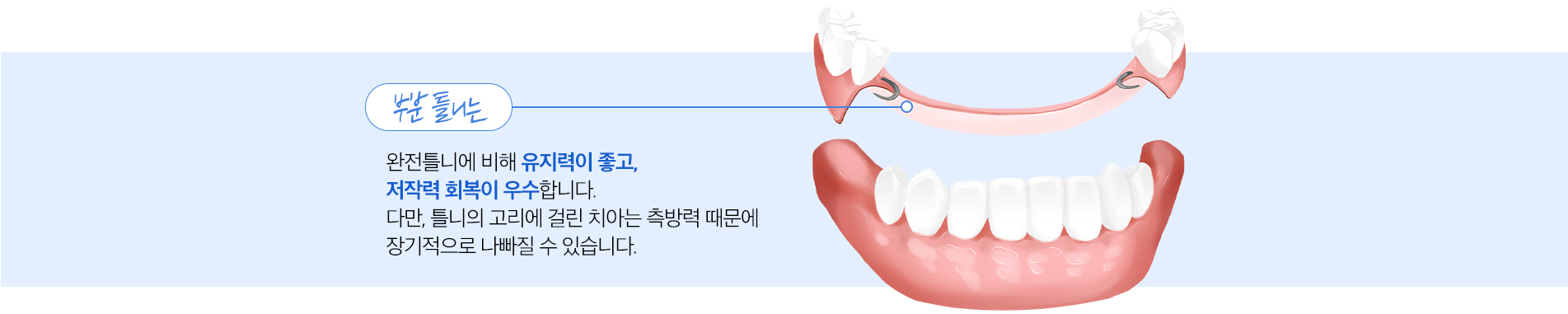 부분틀니