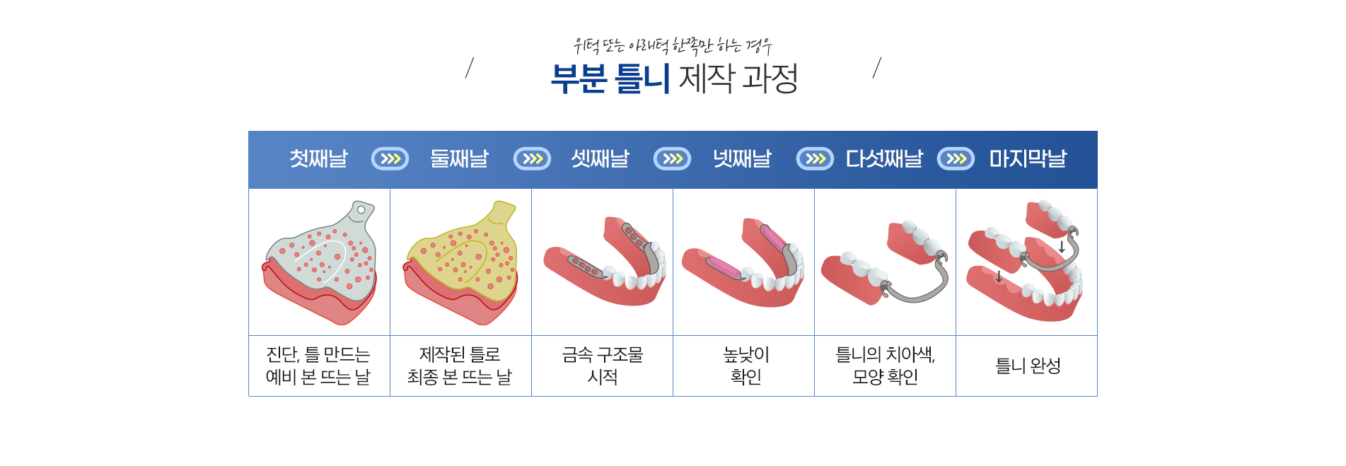 부분틀니