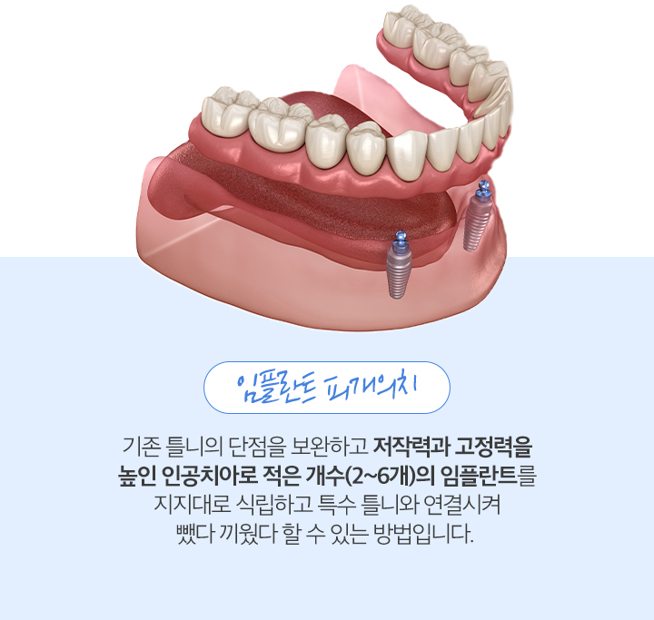 임플란트 피개의치