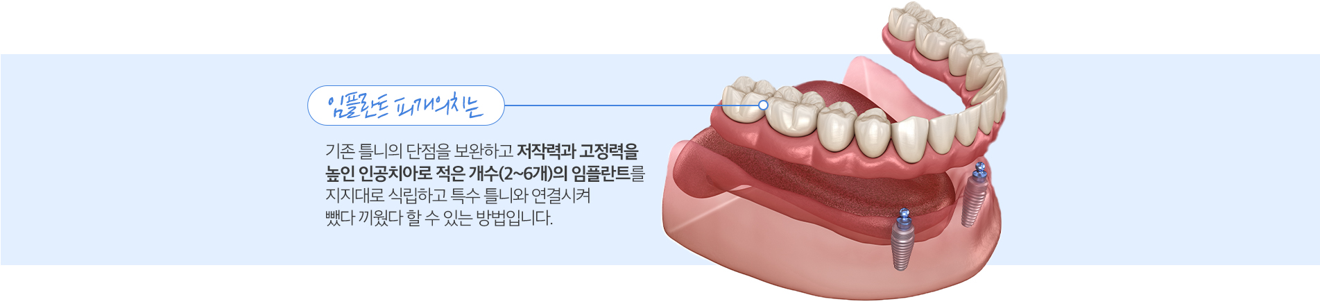 임플란트 피개의치